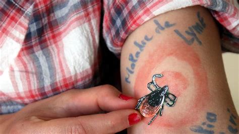 The most common sign of infection is an expanding red rash, known as erythema migrans, that appears at the site of the tick bite about a week after it occurred. Maladie de Lyme : errance dans les salles d'attente