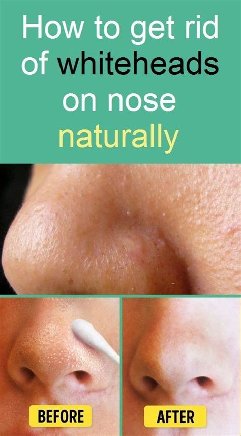 You are probably having an allergic reaction if you are feeling numbness. How to Get Rid of Whiteheads on Nose Naturally | Greasy ...
