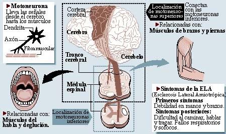 La llamada ela o esclerosis lateral amiotrófica, enfermedad de lou gehrig, es una enfermedad neurodegenerativa. Enfermería de Ciudad Real