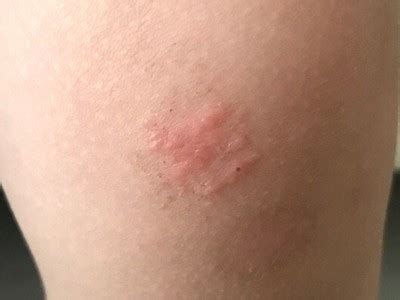 Maybe you would like to learn more about one of these? 虫刺されの症状・対処法…痒みや腫れも | タッキのブログ