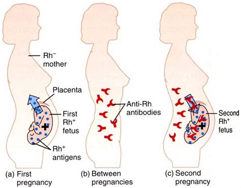 Hal ini dikarenakan organ hati bayi belum cukup matang untuk memproses bilirubin. Nadi_Biologi: ERYTHROBLASTOSIS FETALIS FETUS