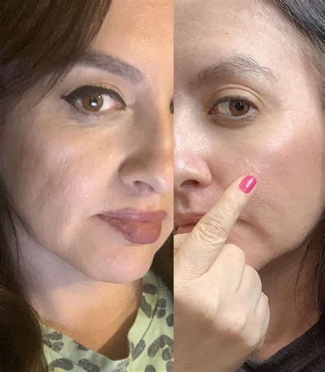 We did not find results for: What To Expect When Getting Cheek Fillers - Life of a ...