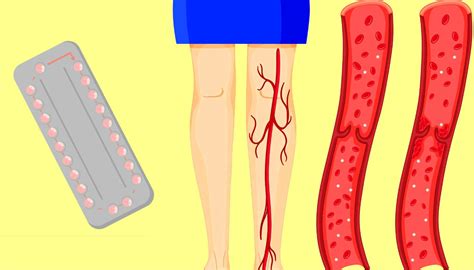 Bij ongeveer de helft van de patiënten is deze ziekte asymptomatisch. Trombose causada por anticoncepcional: sintomas e marcas ...