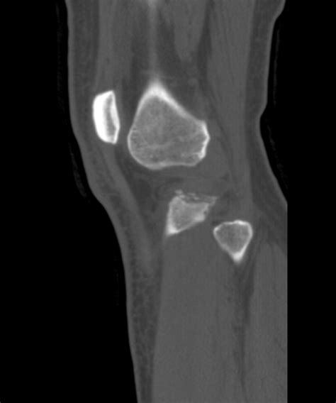 Segond fracture | Image | Radiopaedia.org