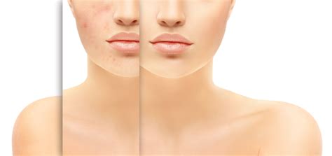 Which causes the skin produce more oil. Is There a Link Between Coffee and Acne? - Ask About Coffee