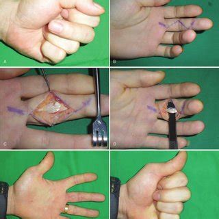 Fds vs fdp (page 1). (PDF) Trigger finger secondary to a neglected flexor ...
