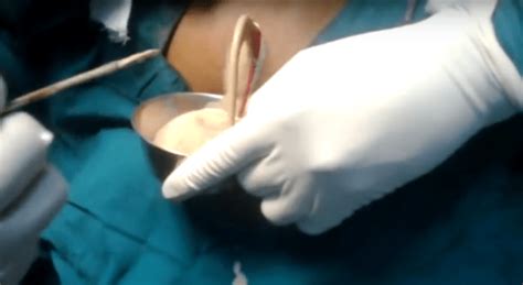 Is there any hole in the wound? Must Watch - Back abscess River of Pus