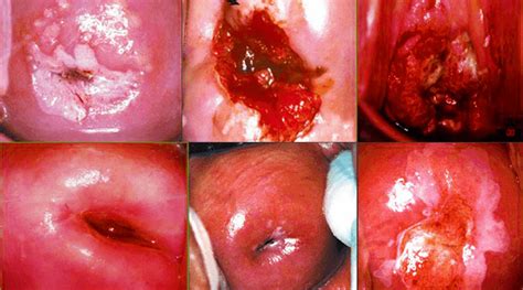 Though there usually are no signs or symptoms of cervical cancer in its early stages, there can be and it's important to be aware of them. CERVICAL CANCER; SYMPTOMS, SIGNS AND CAUSES.