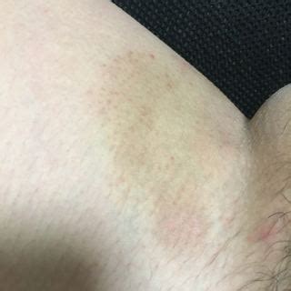 助けてください。 - ちんこが痒すぎて困ってます掻きすぎて股 ...