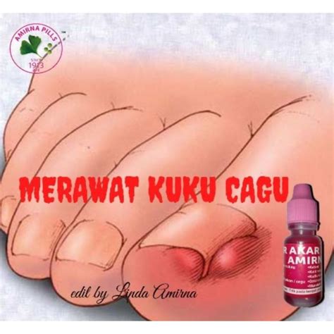 Penyakit kuku yang paling umum terjadi adalah cantengan dan infeksi jamur. UBAT KUKU CAGU/ AMIRNA MULTIPOSE WATER | Shopee Malaysia