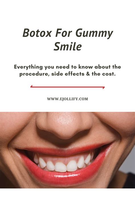 Gummy smile treatment with botox may last for around three months after you may repeat the procedure. Botox For Gummy Smile • The Complete Guide in 2020 | Botox ...