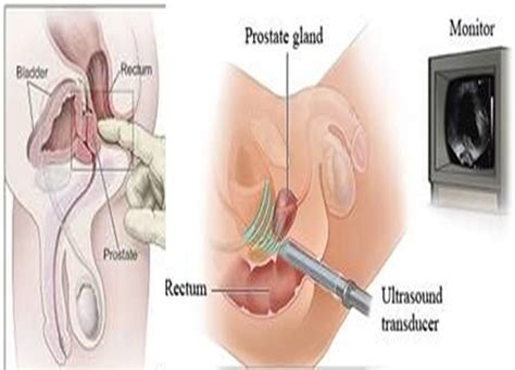 Prostate massage is a way to empty fluids from your prostate ducts. Advanced 3D Prostate Targeted Therapy Successfully Treats ...