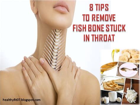 Besides being very unpleasant, the feeling of food stuck in your throat or dysphagia can cause drooling, loss of appetite, pain and pressure in the upper chest. How Do You Remove A Fish Bone From Your Throat? | 8 TIPS ...
