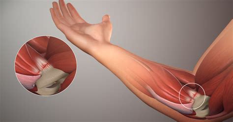 If your pain does not respond to treatments for tennis elbow, your doctor may suggest tests to rule out problems with the radial nerve. Tennis-elbow-pain-golfer-elbow-01