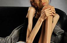 farrokh anorexia woman rachael anorexic california person now battle over who today describes long