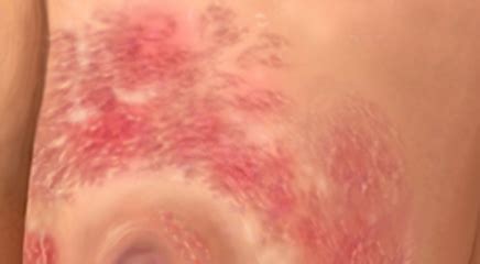 Redness, swelling, tenderness, and changes to the skin of the breast can be signs of inflammatory breast cancer. Inflammatory Breast Cancer: A Disease That Continues to ...