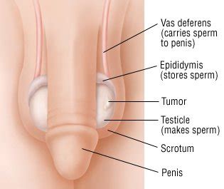 Check nccn or the american cancer society web see below: Testicular Cancer Guide: Causes, Symptoms and Treatment ...