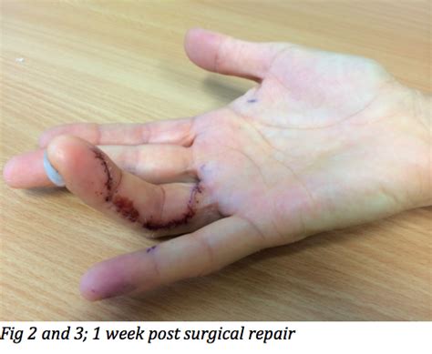 Jersey finger (also called rugby finger or sweater finger) describes a type of injury where there is avulsion of the flexor digitorum profundus (fdp) from the volar base of the distal phalanx base 1. Jersey finger - Dr Bernard Schick (FRACS Ortho)- Hand and ...