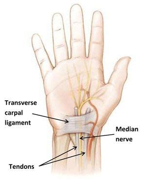 Tendonitis is a inflammation of a tendon, often related to overuse. Wrist Tendonitis, also called #tenosynovitis, is a very ...