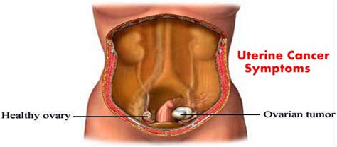 The discomfort and constant cramping from the endometriosis never got significantly what are the symptoms of the primary stage of breast cancer, and how can it be prevented? Types Of Uterine Cancer Tumors - Risk Factors For Uterine ...