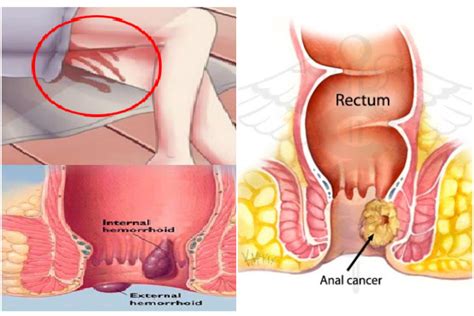 The following symptoms may occur with cancer cancer anus images - coordstudenti