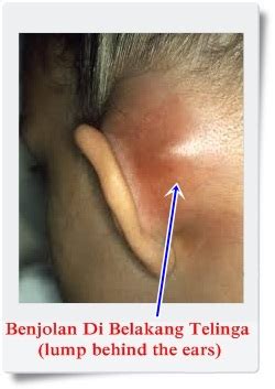 Kelenjar getah bening adalah bagian dari sistem daya tahan jika benjolan di belakang telinga karena kelenjar getah bening bengkak terjadi lebih dari dua minggu, segera konsultasikan ke dokter. Bengkak Di Belakang Telinga Kanan - Informasi Kesehatan 2020