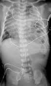 Congenital diaphragmatic hernia (cdh) is usually classified based on anatomic position of defect1,2,3,5. Congenital diaphragmatic hernia | Radiology Reference ...