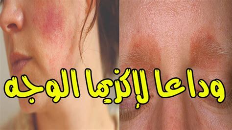 كيفية سرعة علاج نزلة البرد. علاج اكزيما الجلد بالاعشاب , التخلص من الاكزيما بطرق ...