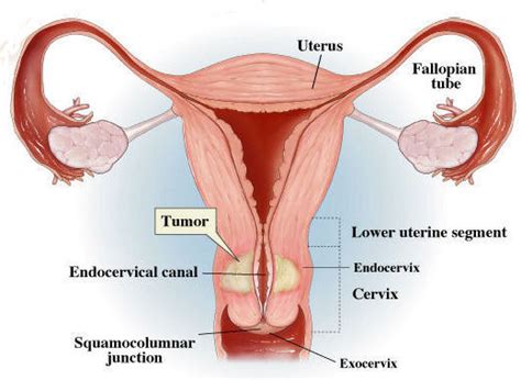 Segera periksakan diri ke dokter jika kamu mengalami nyeri panggul saat berhubungan intim, untuk memastikan apakah kondisi ini tanda penyakit kanker serviks atau akibat penyakit lain, seperti endometriosis atau fibroid. Gejala Kanker Serviks, Penyebab dan Faktor Resiko