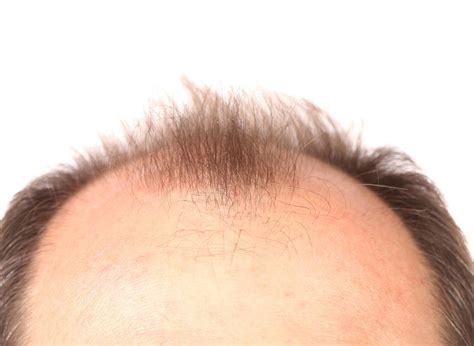 These hairstyles can put stress on the hair that causes the shafts to break off and the hair to fall out. How To Stop Hair Loss | LloydsPharmacy Online Doctor UK
