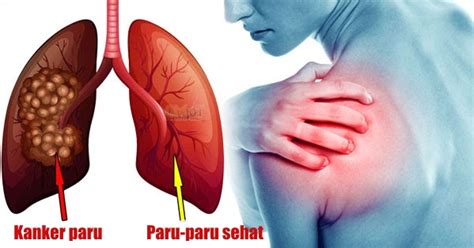 Jangkitan muka biasa dan banyak terjadi di dalam pengamalan perubatan dan pergigian. 10 Cara Mencegah Penyakit Paru-Paru Akut dan Kronis