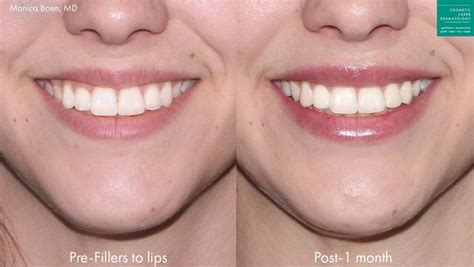 Order wholesale restylane kysse from medica depot to help restore your patient's lips to the plump, smooth appearance of their youth. Restylane Kysse San Diego, CA | Cosmetic Laser Dermatology