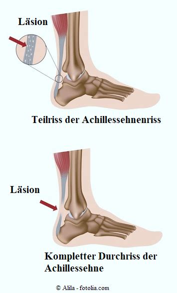 Einem riss der achillessehne geht meist eine. Achillessehnenriss, Dauer, Achillessehneruptur ...