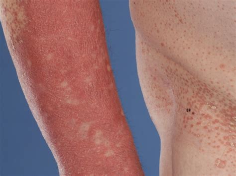 Pityriasis rubra pilaris is a group of rare and chronic skin disorder characterized by unvarying inflammation of the skin associated with shedding. Pityriasis rubra pilaris (PRP)