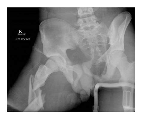 Significant Rate of Misuse of the Hare Traction Splint for ...