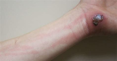 Identify sepsis patients 6 hours earlier. Lymphangitis: Causes, symptoms, and pictures