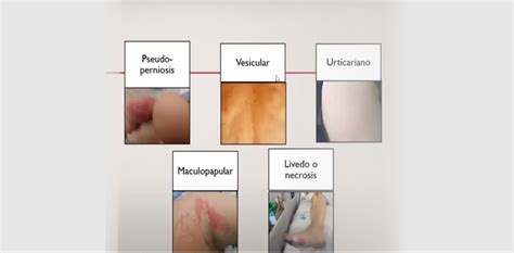 As erupções cutâneas associadas à covid parecem ser tão numerosas quanto difíceis de identificar, disse o dermatologista. Lesões de Pele associadas à COVID-19 - Enfermagem Piauí