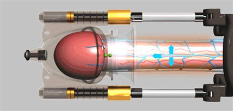 تتضمن مضخات القضيب وضع أنبوب فوق القضيب ثم ضخ الهواء تتضمن هذه التقنية وضع وزن أو إطار تمديد صغير، يُطلق عليه أحيانًا جهاز الجر، على. Best Non-Surgical Treatment For Peyronie's Disease