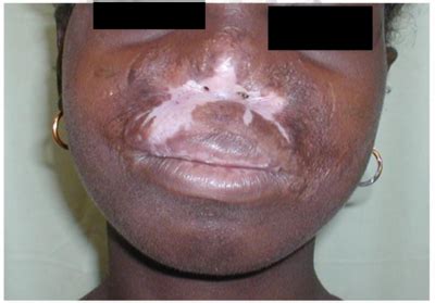 Tuberculosis cutis orificialis (also known as acute tuberculous ulcer 1 ) is a form of cutaneous tuberculosis that occurs at the mucocutaneous borders of the nose, mouth, anus, urinary meatus. Internet Scientific Publications