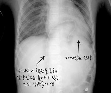 ② 알레르기 또는 알레르기 유발 심근염, 병원성 미생물에 의해 유발 박테리. 아이심장