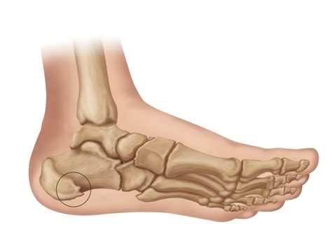 Explore the site, discover the latest spurs news & matches and check out our new stadium. Heel Spur Symptoms & Treatments | Heel That Pain