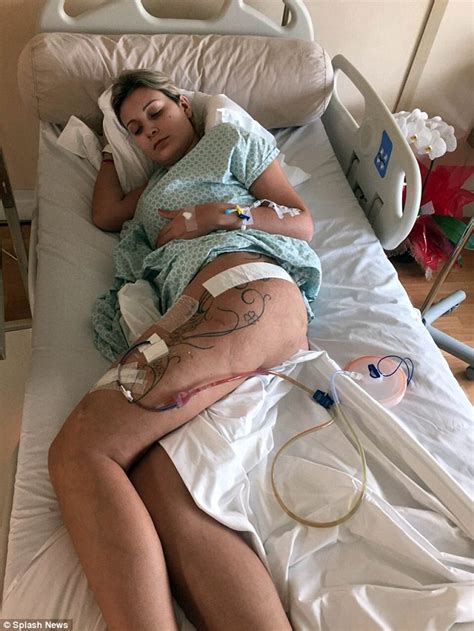 Miss bumbum contestant's surgery nightmare (graphic photo). Miss BumBum contestant Andressa Urach has toxic substances ...