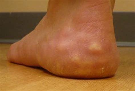 We did not find results for: What are Piezogenic Papules? - Almawi Limited The Holistic ...