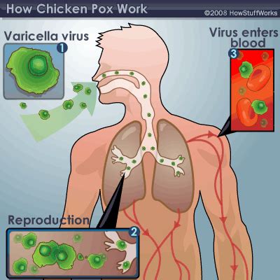 Parut chicken pox atau jerawat dan jeragat dapat dihilangkan. Tanda dan Rawatan Gastrik | SihatSelalu