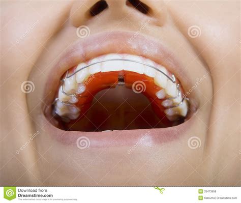 How to clean dirty retainers. Close Up Of Smiling Teeth With Retainer Stock Photo ...