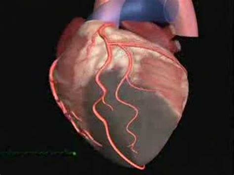 Con fibrillazione ventricolare (fv o vf) in medicina si intende una gravissima aritmia che si caratterizza per un ritmo cardiaco rapidissimo, caotico e disorganizzato che origina dai ventricoli. FIBRILLAZIONE VENTRICOLARE - YouTube
