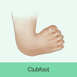 J bone joint surg am. Surgical Treatment for clubfoot in Children | Posts by MD ...