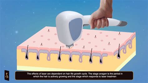 Click here to learn everything you need to know. Laser Hair Removal and Electrolysis - YouTube