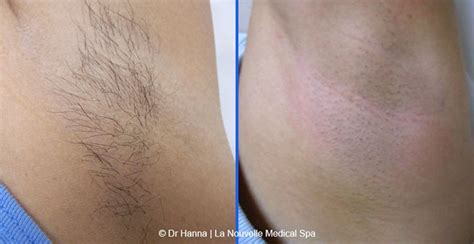 Learn more at el paso plastic surgery. Laser Hair Removal Fotos antes y después | Oxnard, Ventura