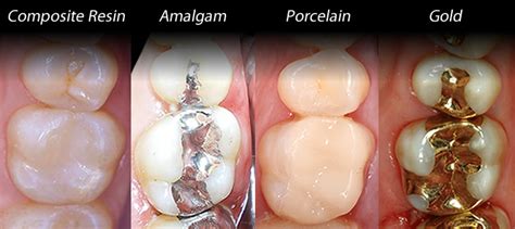 They usually fall out, fracture, or wear out within 1 month. How long do fillings last? | Windsor Dentists